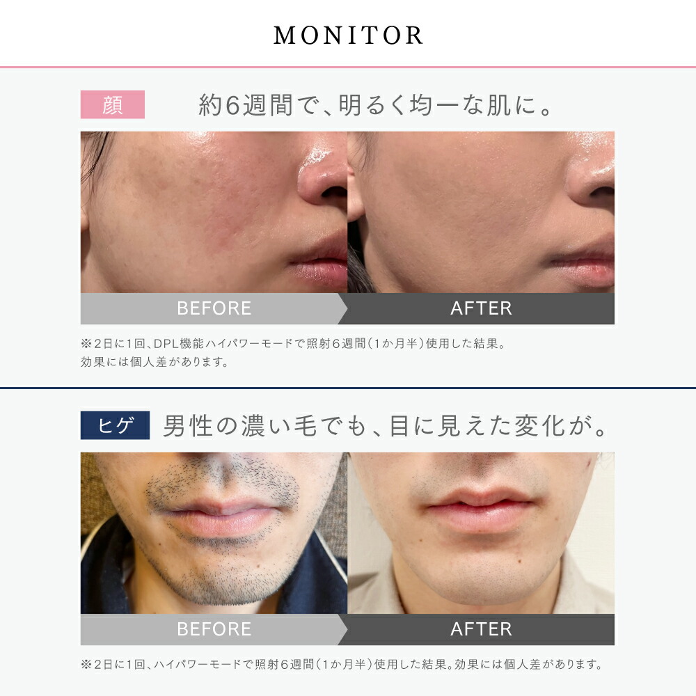 楽天市場】【公式｜期間限定 25%OFFクーポン】リンチーリン愛用 脱毛器