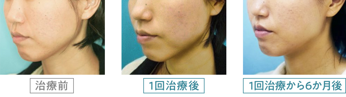 サーマクール | 大阪でサーマクールを施すなら「つかはらクリニック」