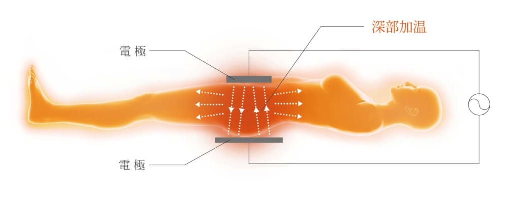 インディバ系インディバの機能に似たマシンラジオ波モノポーラ