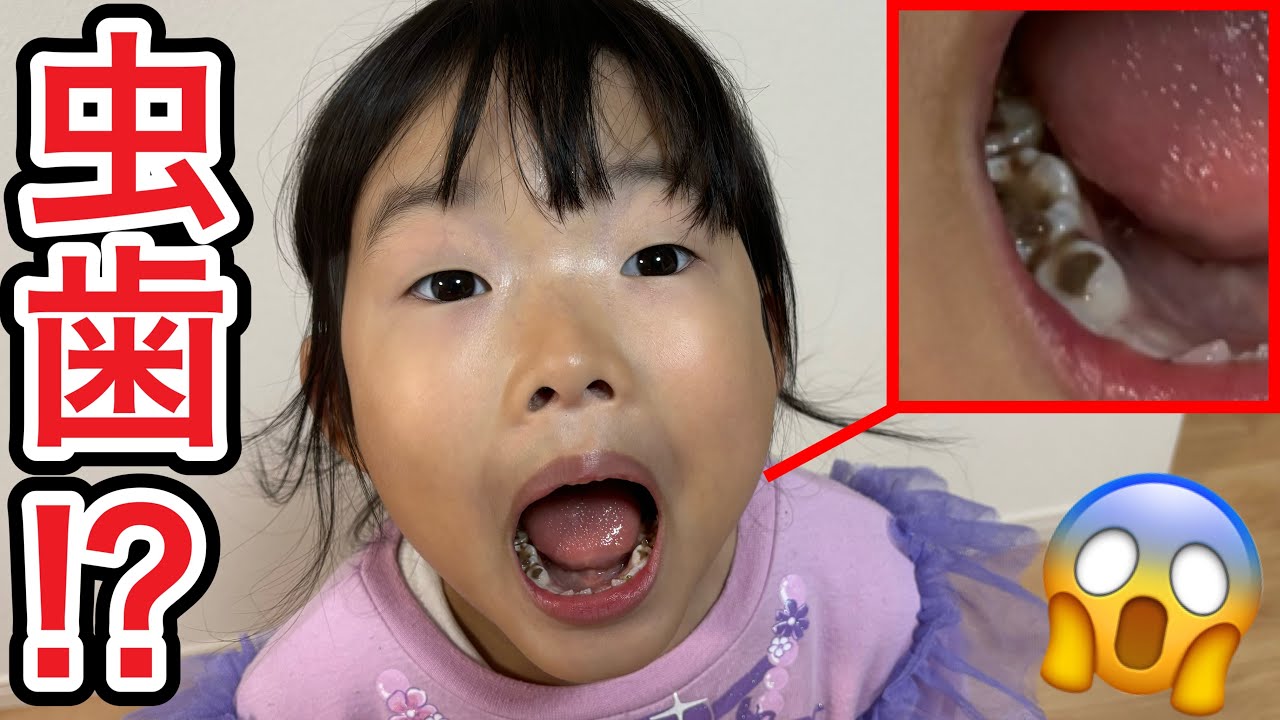 Huh? Koko-chan finally has a cavity!? 😱😱😱😱😱 - YouTube