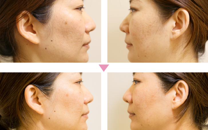 サーマルフラクショナル リフトアップ！ サーマクール 徳島